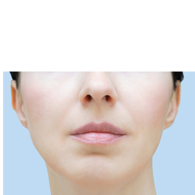 Mundwinkel-Lifting – Behandlung bei Premium Aesthetic Wolfsburg