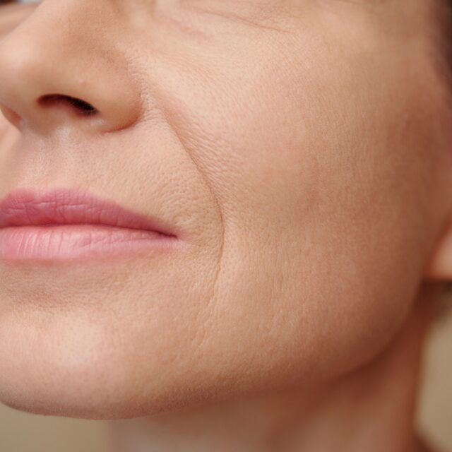 Nasolabialfalten – Behandlung bei Premium Aesthetic Wolfsburg