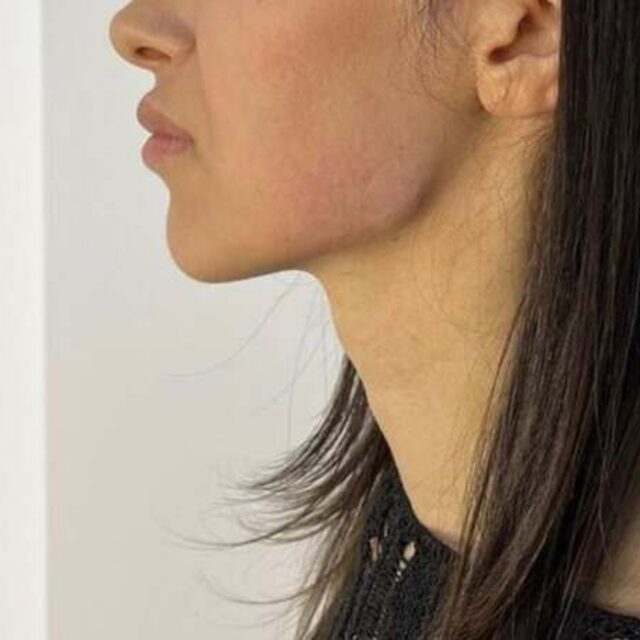 Jawline-Konturierung – Behandlung bei Premium Aesthetic Wolfsburg