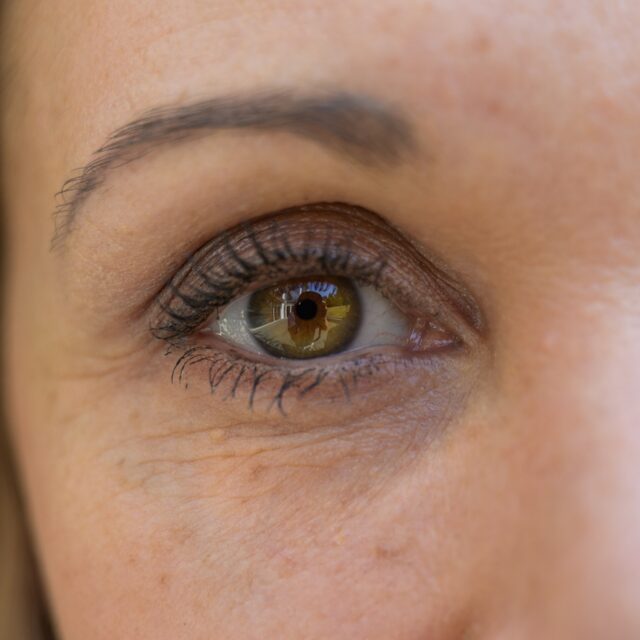 Augenringe & Tränenrinne – Behandlung bei Premium Aesthetic Wolfsburg