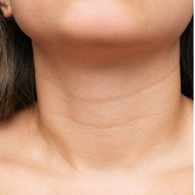 Halsfalten & Dekolleté – Behandlung bei Premium Aesthetic Wolfsburg