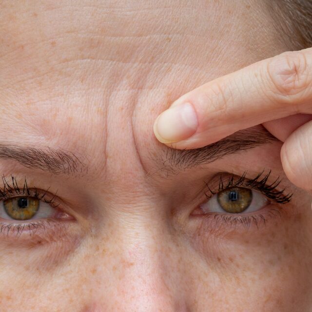 Zornesfalte – Behandlung bei Premium Aesthetic Wolfsburg