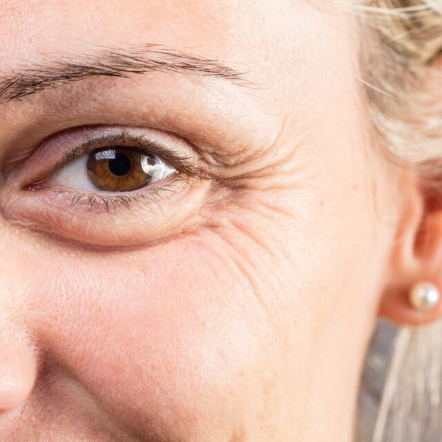 Krähenfüße – Behandlung bei Premium Aesthetic Wolfsburg