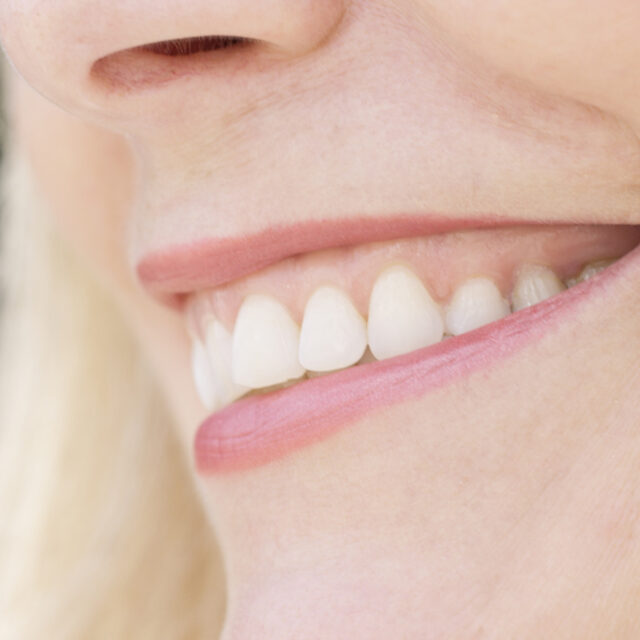 Gummy Smile – Behandlung bei Premium Aesthetic Wolfsburg